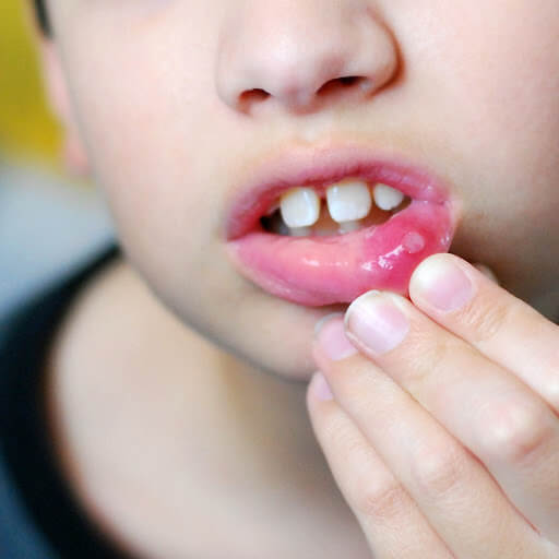 preventing-mouth-ulcers-in-babies-children-best-pediatricians-in-noida