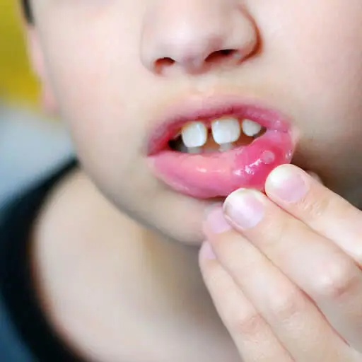 How to prevent mouth ulcer in children