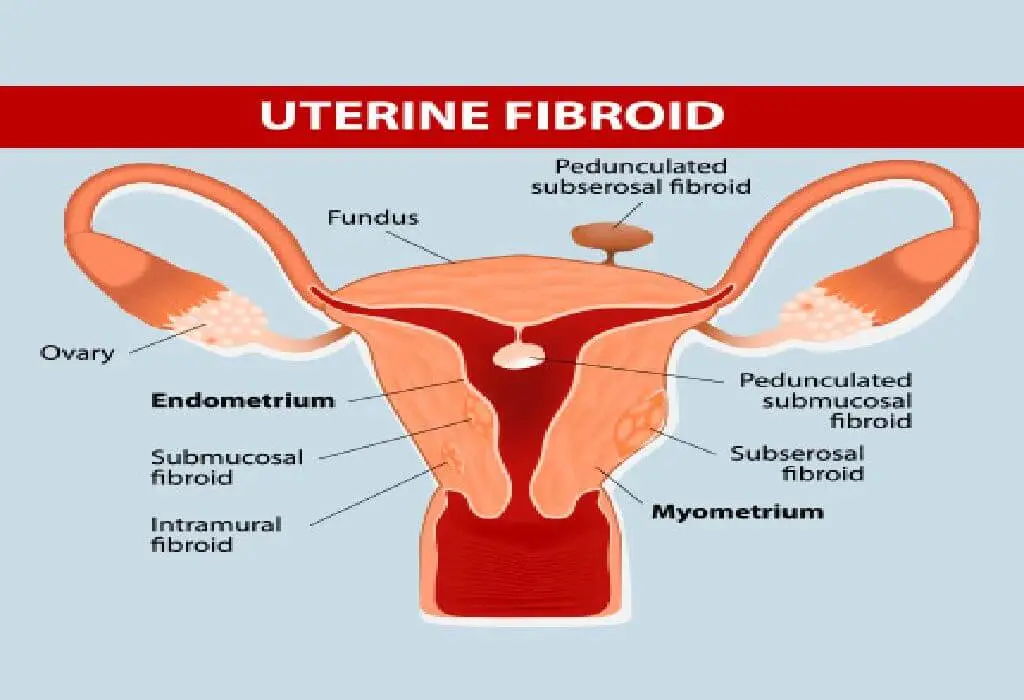 uterine fibroid effect on infertility